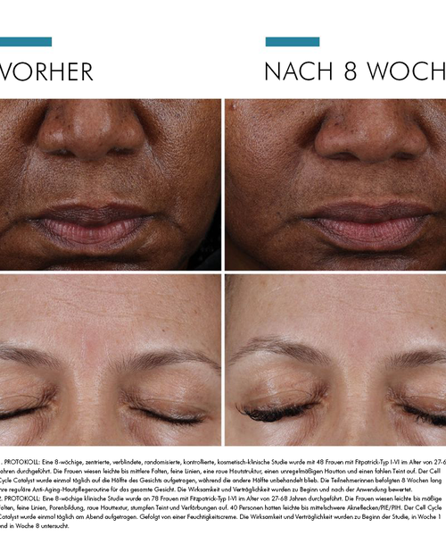 Vorher-Nachher-Bilder einer Hautbehandlung bei einer Frau, zeigt dramatische Verbesserung nach 8 Wochen.
