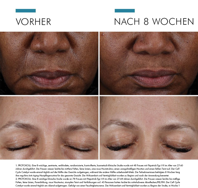 Vorher-Nachher-Bilder einer Hautbehandlung bei einer Frau, zeigt dramatische Verbesserung nach 8 Wochen.
