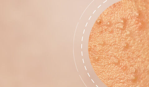 Close-up of a textured skin surface with small bumps and a blurred background.