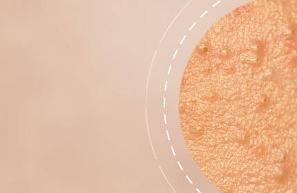 Close-up of a textured skin surface with small bumps and a blurred background.