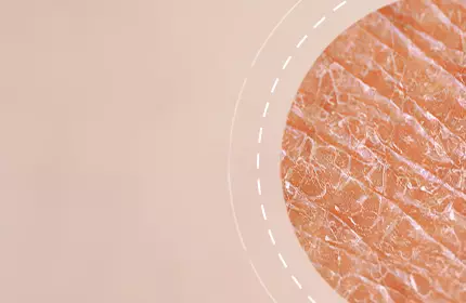 Close-up of textured skin with a soft, neutral background.